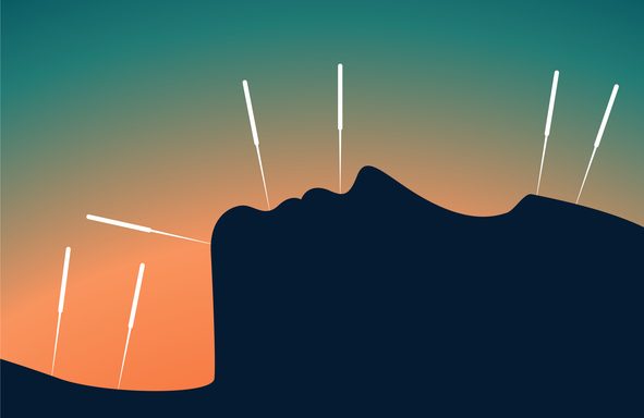 akupunktura, benefiti